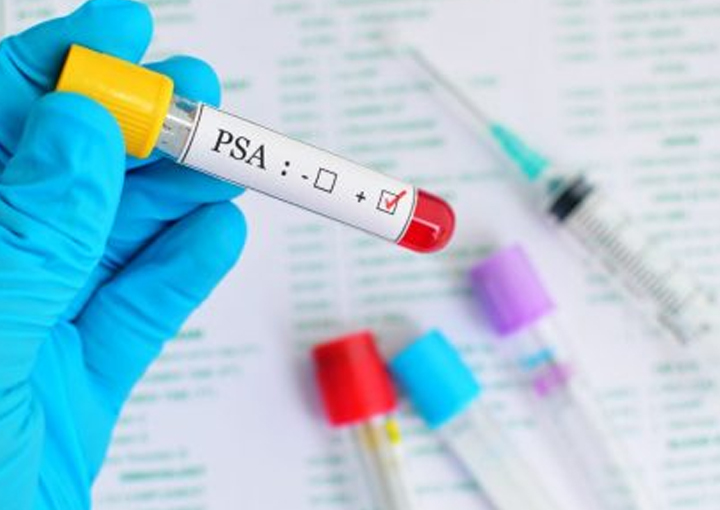 PSA (Prostate specific antigen) | Bioclinica